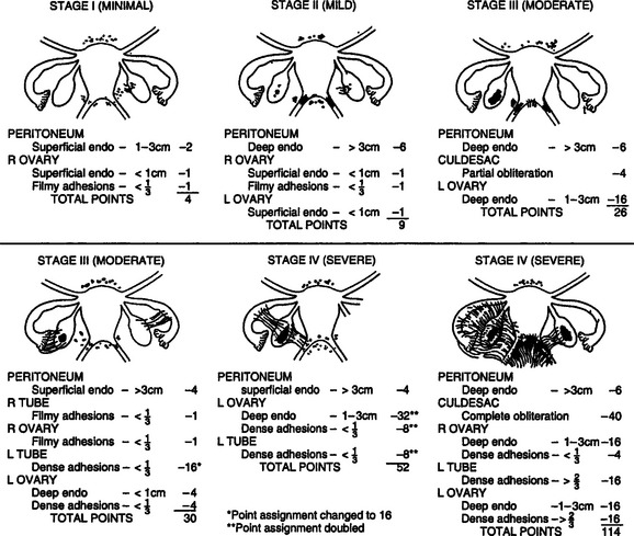 Endometriosis | Abdominal Key